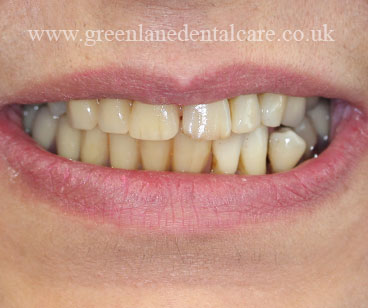 After upper and partial denture (mimicking remaining natural teeth)