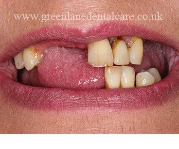 Before upper and partial denture (mimicking remaining natural teeth)