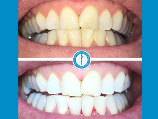 Air Polish Before and After